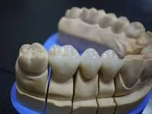 Coroas de Porcelana Fundido a Metal (PFM) - China Dent