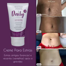 Creme Daily tratamento para Estrias Michelle Marques