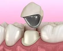  Processamento de próteses dentárias, processamento de dentes de porcelana, processamento de dentes de porcelana, processamento de dentes de toda a porcelana, fabricantes de próteses dentárias de processamento de implantes dentários